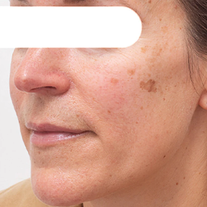 AEXZR® Herbal Flecken Peel-Off Gesichtsmaske  | BEGRENZTES RABATTANGEBOT✨