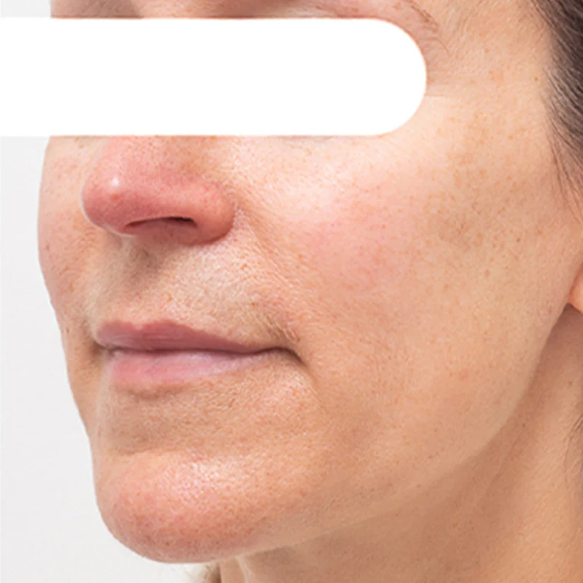 AEXZR® Herbal Flecken Peel-Off Gesichtsmaske  | BEGRENZTES RABATTANGEBOT✨